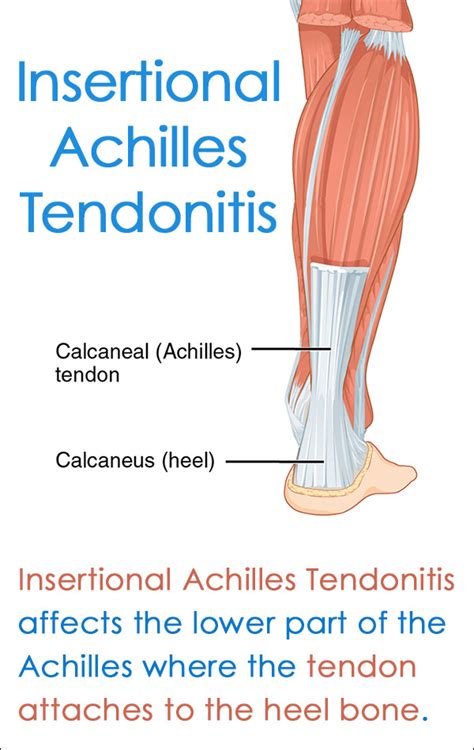 Insertional Achilles Tendinitis Santa Barbara Deep Tissue Riktr