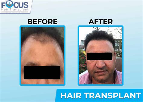 Hair Transplant In Punjab India Hair Transplant Centre In Jalandhar