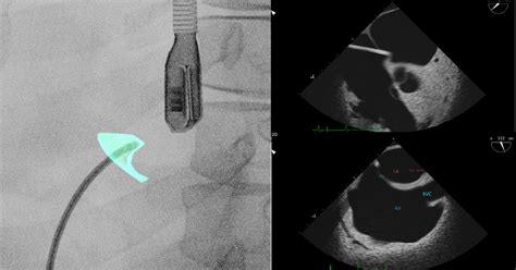 Proven Steps For A Successful Transseptal Puncture Tsp Mentice Blog