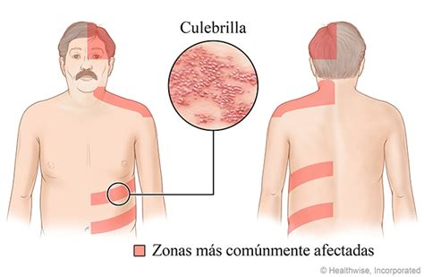 Como Se Activa La Culebrilla Virolico