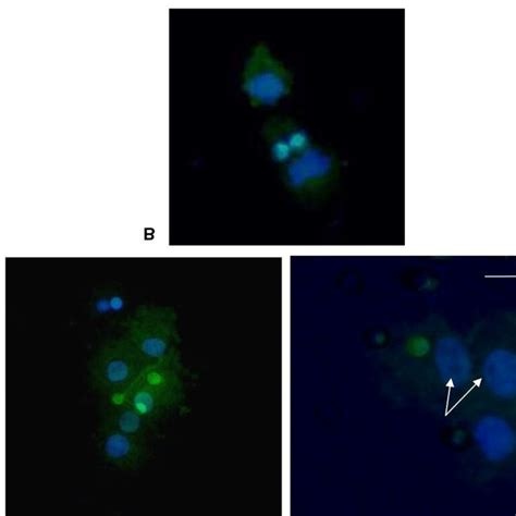 Circulating Tumor Cells Ctcs Isolated From Blood Of Patient I With