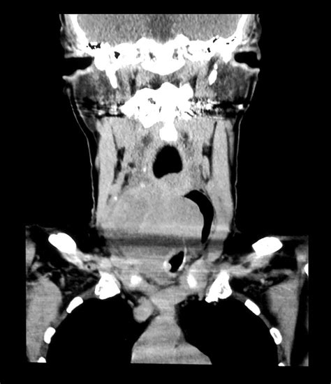 Anaplastic Carcinoma Of Thyroid Gland Bild Kaufen 12642077