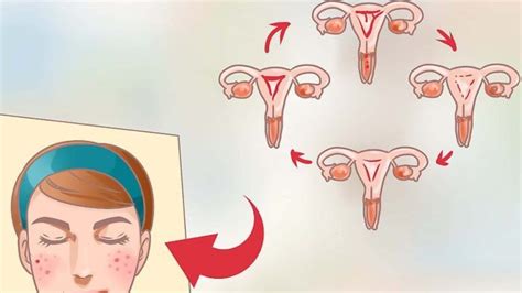 Acné Hormonal Causas Y Tratamientos