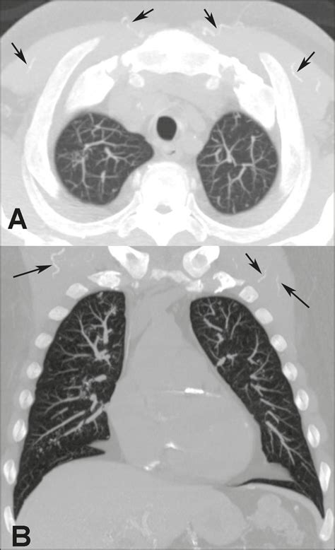 Scielo Brasil Metastatic Pulmonary Calcification High Resolution Computed Tomography Findings