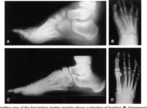 Figure 4 From Anterior Tibial Tendon Transfer In Residual Dynamic Clubfoot Deformity Semantic