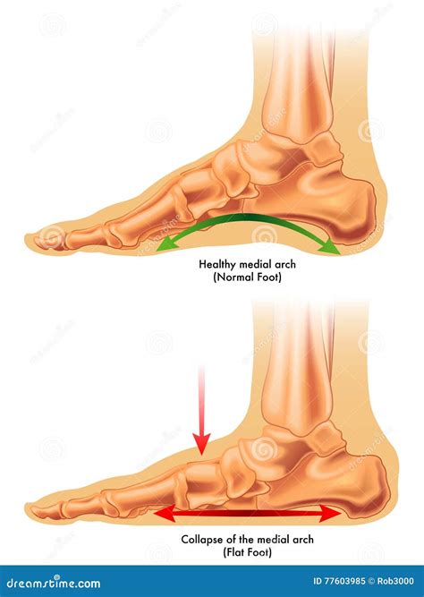 Flat foot stock vector. Illustration of damaged, pain - 77603985