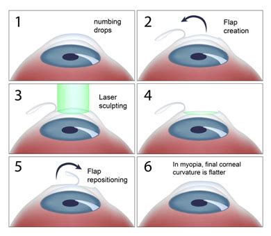 Delaware Eye Clinic | CustomVue LASIK (WaveFront Technology)