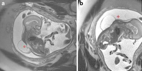 Prenatal MRI That Reveals A Non Terminal Thoracolumbar Myelocystocele