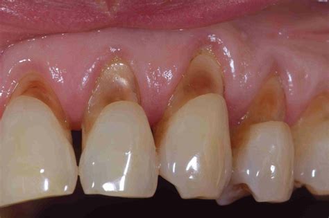 abrasi gigi gejala penyebab pengobatan dll  sehat