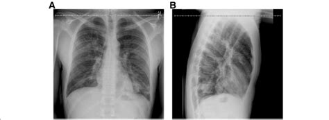 Chest X Ray On Admission Pa And Lateral View Patchy Infiltrates Can