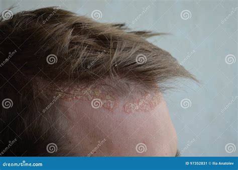 Psoriasis On The Skin Close Up Scalp Photos Of Dermatitis And Eczema