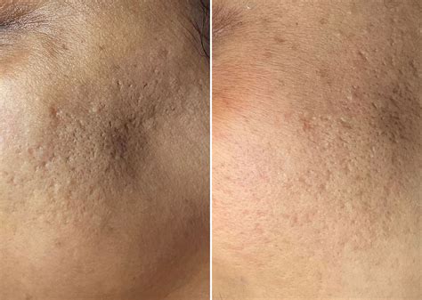 Skinpen Microneedling Photos Houston Tx Patient