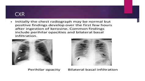 Hydrocarbon Poisoning Ppt