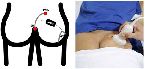 Piriformis Injection Landmarks