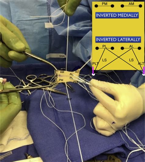 Suture Placement In The Graft Used For Superior Capsular Reconstruction