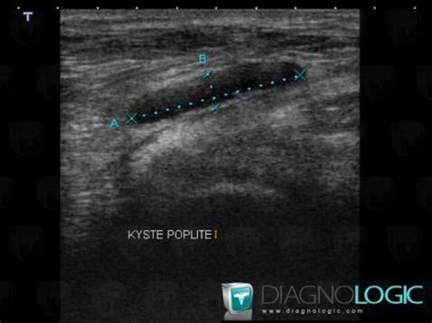 Cas radiologie Kyste poplité Echographie Diagnologic