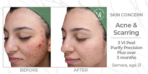 Chemical Peels Virginia Washington D C And Maryland