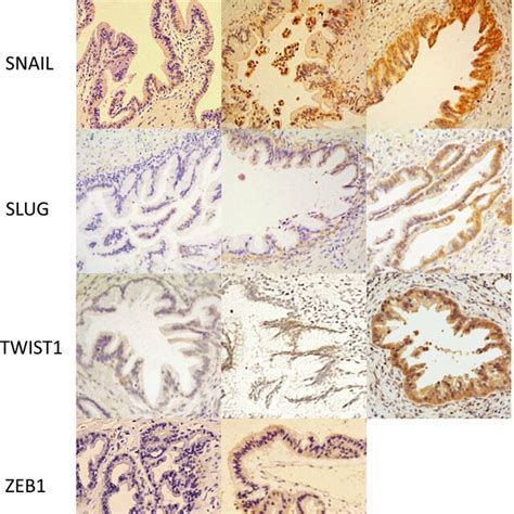 Expression Of Snail And Slug In Hg‐panin And Pdac Expression Levels In Download Scientific