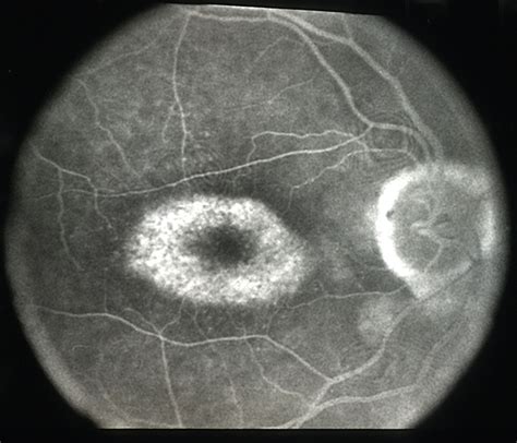 Cone dystrophy case 2 image 3 - FA - Retina Image Bank