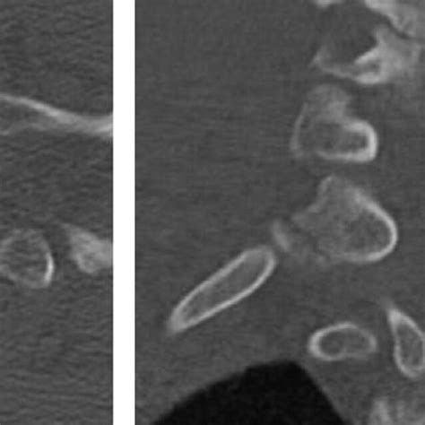 A Select Axial Ct Cut Of An Isolated Lumbar Transverse Process Download Scientific Diagram