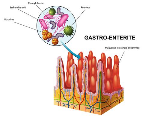 Combien De Temps Dure Une Gastro