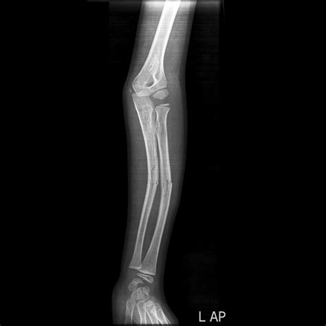 greenstick fracture wikidoc