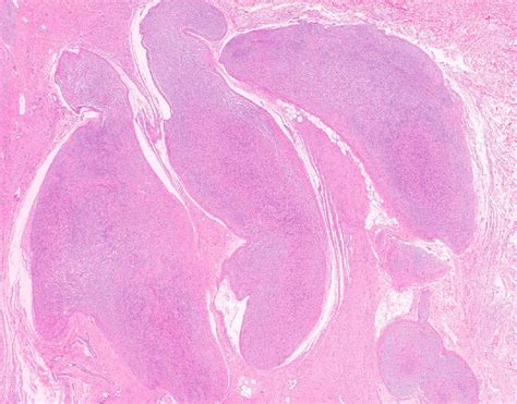 Neurogenic Tumours Of The Posterior Mediastinum And Differential