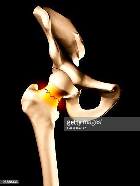 37 Hip Bone Fracture Stock Photos, High-Res Pictures, and Images ...