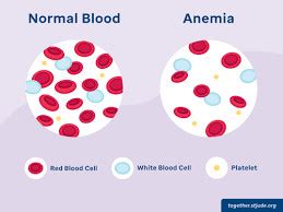 Anemia Definisi Penyebab Gejala Dan Tata Laksana Ai Care