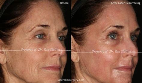 Laser Skin Resurfacing Before And After Photo Gallery New York City