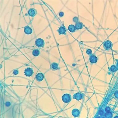 Histoplasma capsulatum var. capsulatum on bone marrow smear ...