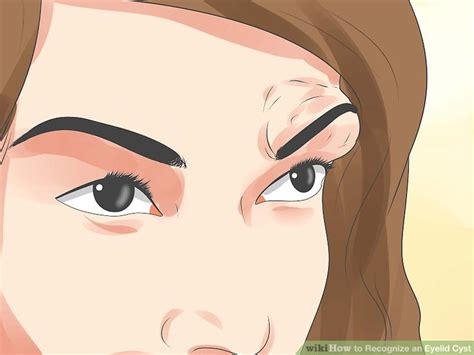 How to Recognize an Eyelid Cyst: 12 Steps (with Pictures)