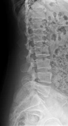 Spina Bifida Occulta Image Radiopaedia Org