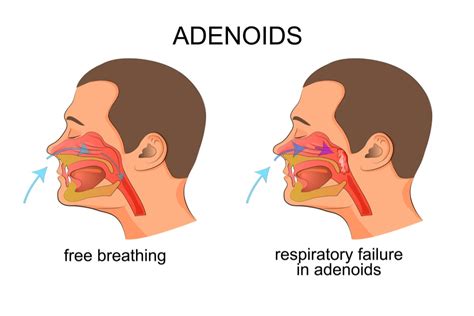 Obstructive Sleep Apnea The Definitive Guide For 20120