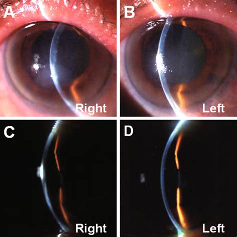 A D Anterior Segment Of A 77 Year Old Woman At Her Fi Rst Visit A B