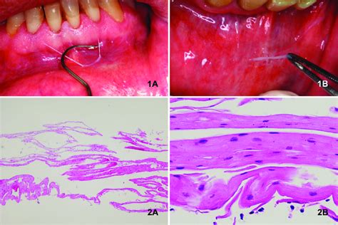 1a Epithelial Desquamation In Alveolar Mucosa 1b Peeling Biopsy