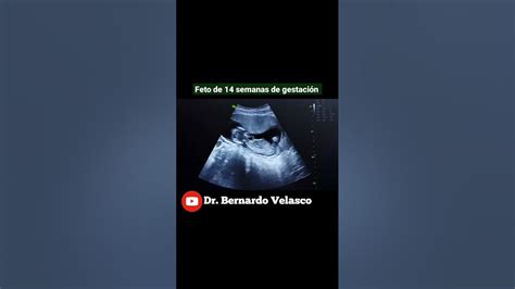 Feto De 14 Semanas De GestaciÓn Youtube