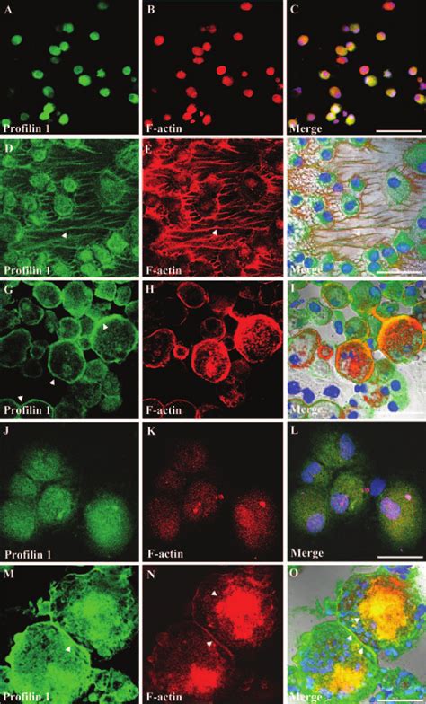 Profilin 1 And Actin Distribution In HIV 1 Infected MDM Human MDM