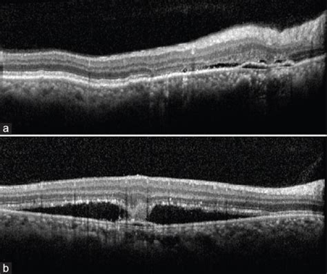 Central Serous Chorioretinopathy Current Update On Pathophysiology And