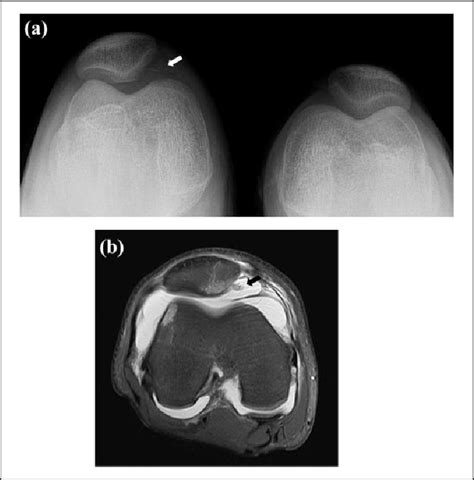 Medial Patellar Subluxation