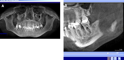 Revisi N De Art Culo Dento Metric Radiolog A Dental Oral Y