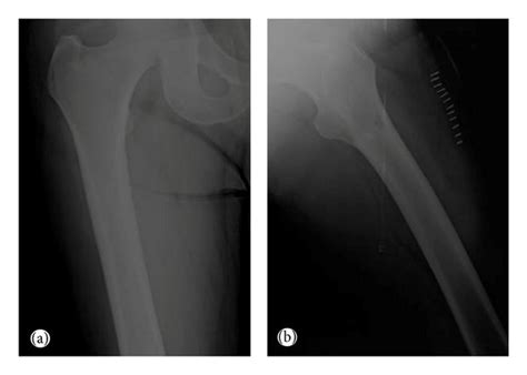 Anteroposterior Radiographs Of Both Femurs A Mixed Lytic Sclerotic