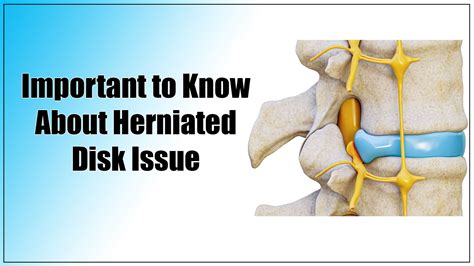 What Is Herniated Disk How Can Physical Therapists Help In The