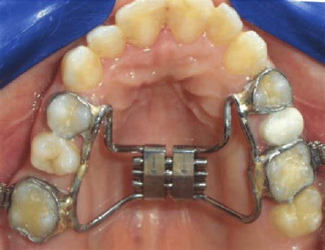 Hyrax Appliance Rapid Maxillary Expansion