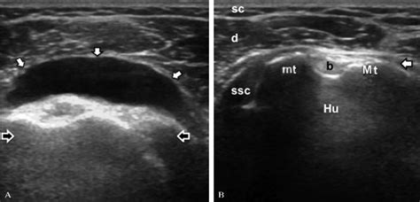 Subacromial Subdeltoid Bursitis Mri