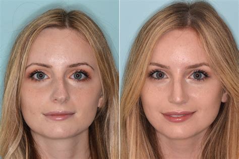 Fixing A Crooked Nose With Rhinoplasty Miami Fl