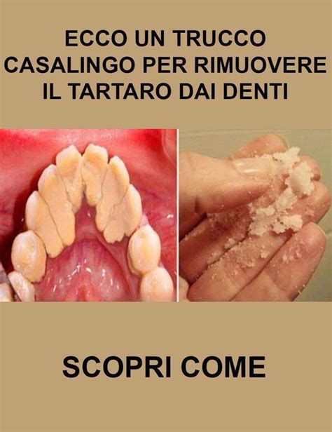 ECCO IL TRUCCO CASALINGO PER RIMUOVERE IL TARTARO DAI DENTI