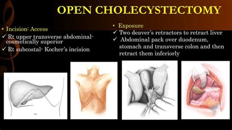 Open cholecystectomy/ operative surgery