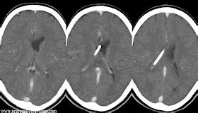 Dr Balaji Anvekar Frcr Csf Shunt Imaging