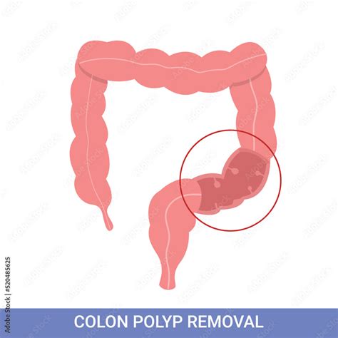 Colonoscopy intestine, polypectomy procedure, removal polyp in colon ...